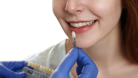 Mặt dán sứ Veneer Siêu mỏng