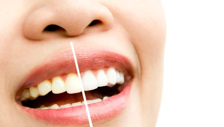 Tẩy Trắng Răng Laser Whitening
