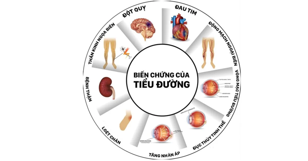 당뇨병(DM) 환자를 위한 필수 기초 상식 - 이미지 2 - SANTE 병원 빈탄, 호치민