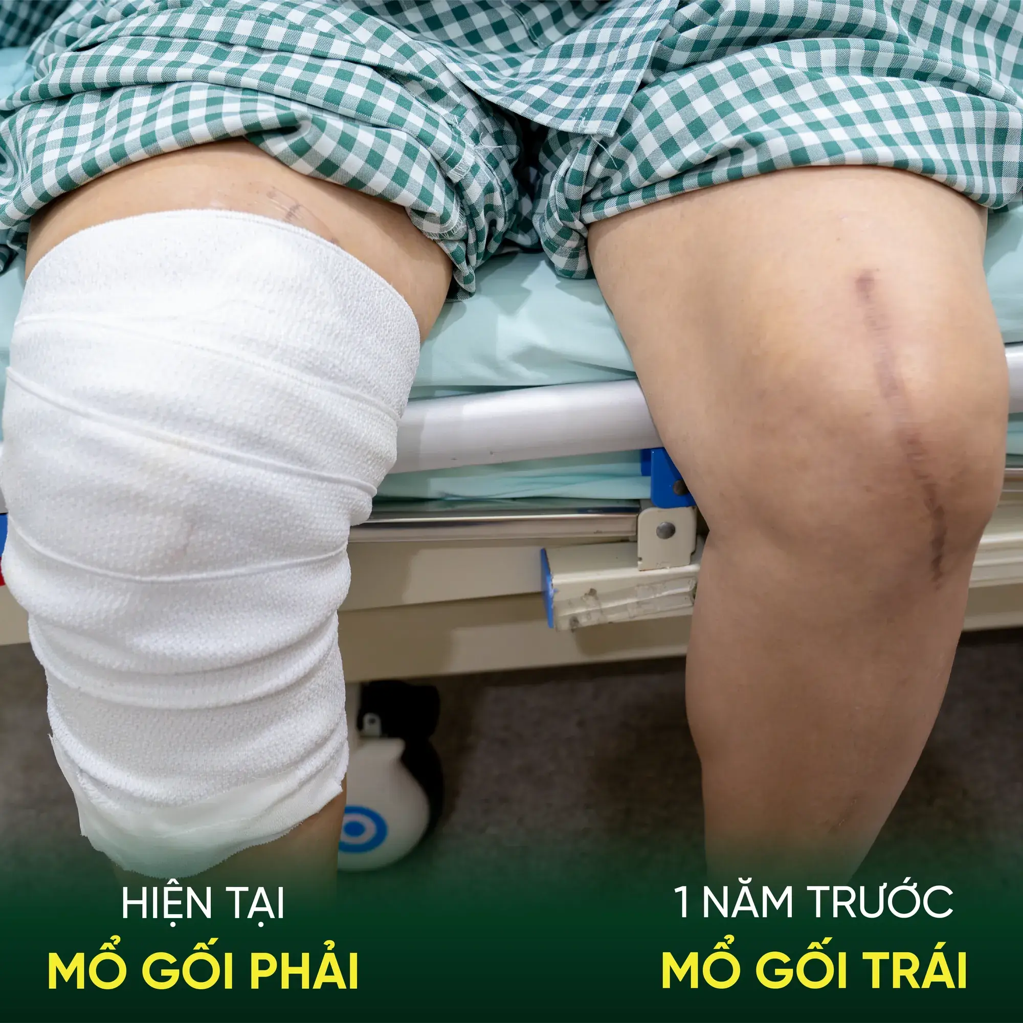 Comparative assessment of bilateral knee recovery outcomes for patient Huong at Sante Hospital