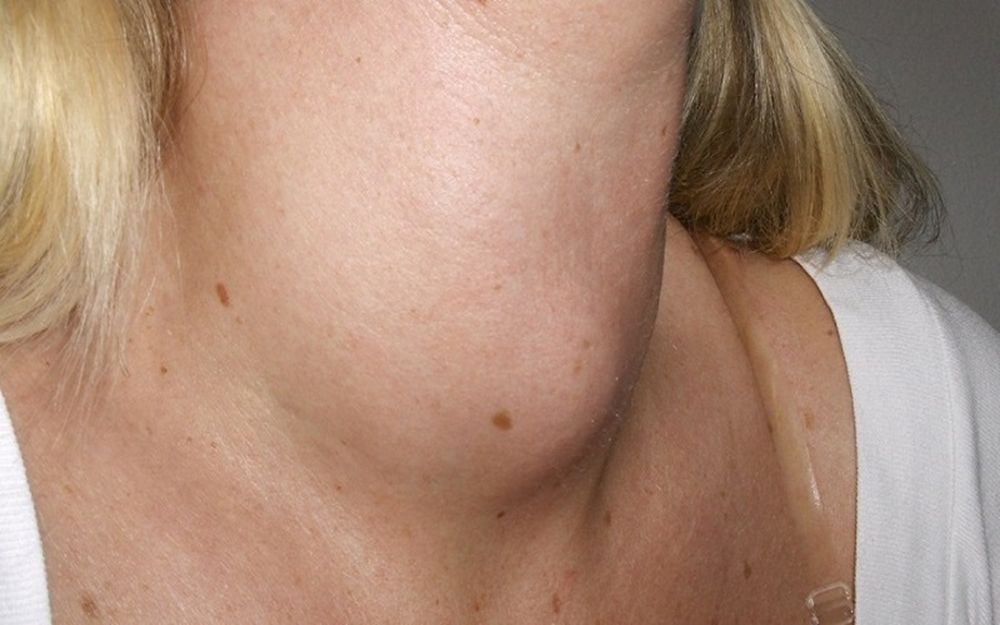 Bướu cổ là bệnh gì? Nguyên nhân, cách phòng bướu cổ