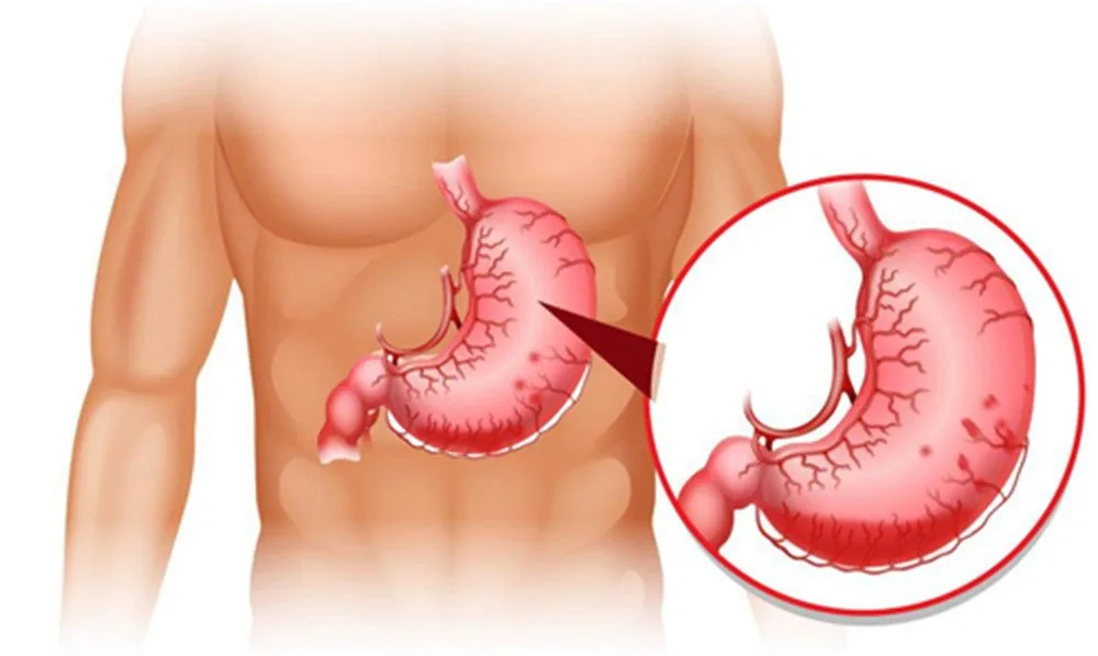 Sante Hospital - Gastroptosis - Causes, Symptoms, and Treatment