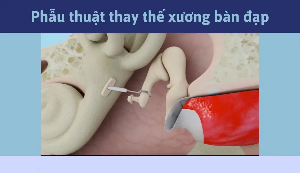 BỆNH LÝ XỐP XƠ TAI LÀ GÌ? NGUYÊN NHÂN TRIỆU CHỨNG VÀ PHƯƠNG PHÁP ĐIỀU TRỊ - Hình 2 - Bệnh viện SANTE Bình Thạnh, TP.HCM