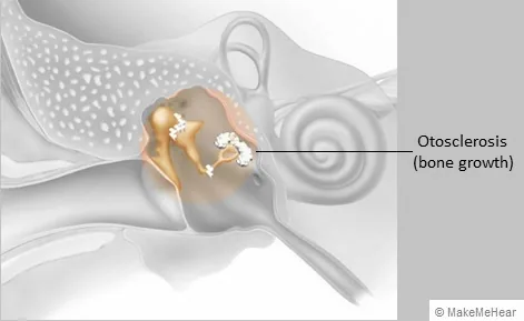 BỆNH LÝ XỐP XƠ TAI LÀ GÌ? NGUYÊN NHÂN TRIỆU CHỨNG VÀ PHƯƠNG PHÁP ĐIỀU TRỊ - Bệnh viện SANTE Bình Thạnh, TP.HCM