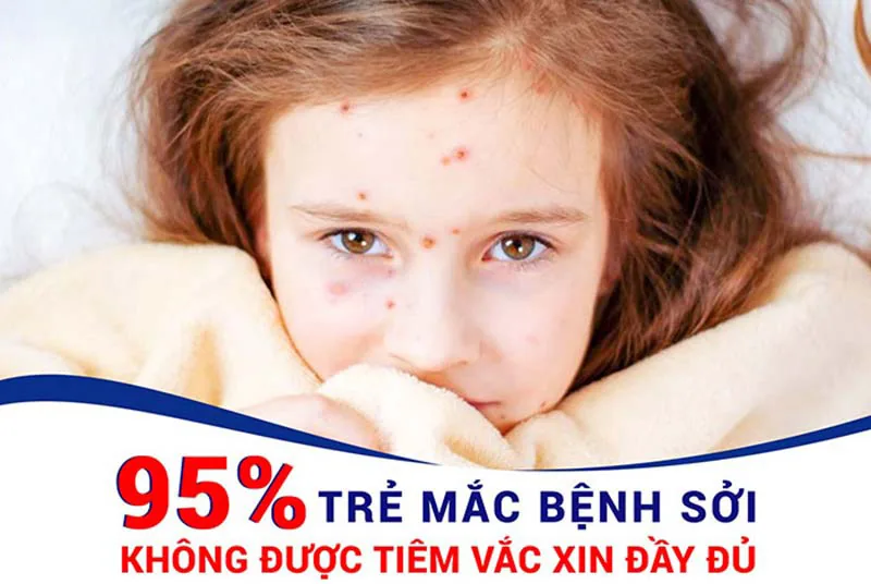 BỆNH SỞI  NGUYÊN NHÂN, TRIỆU CHỨNG VÀ BIỆN PHÁP PHÒNG NGỪA - Hình 2 - Bệnh viện SANTE Bình Thạnh, TP.HCM