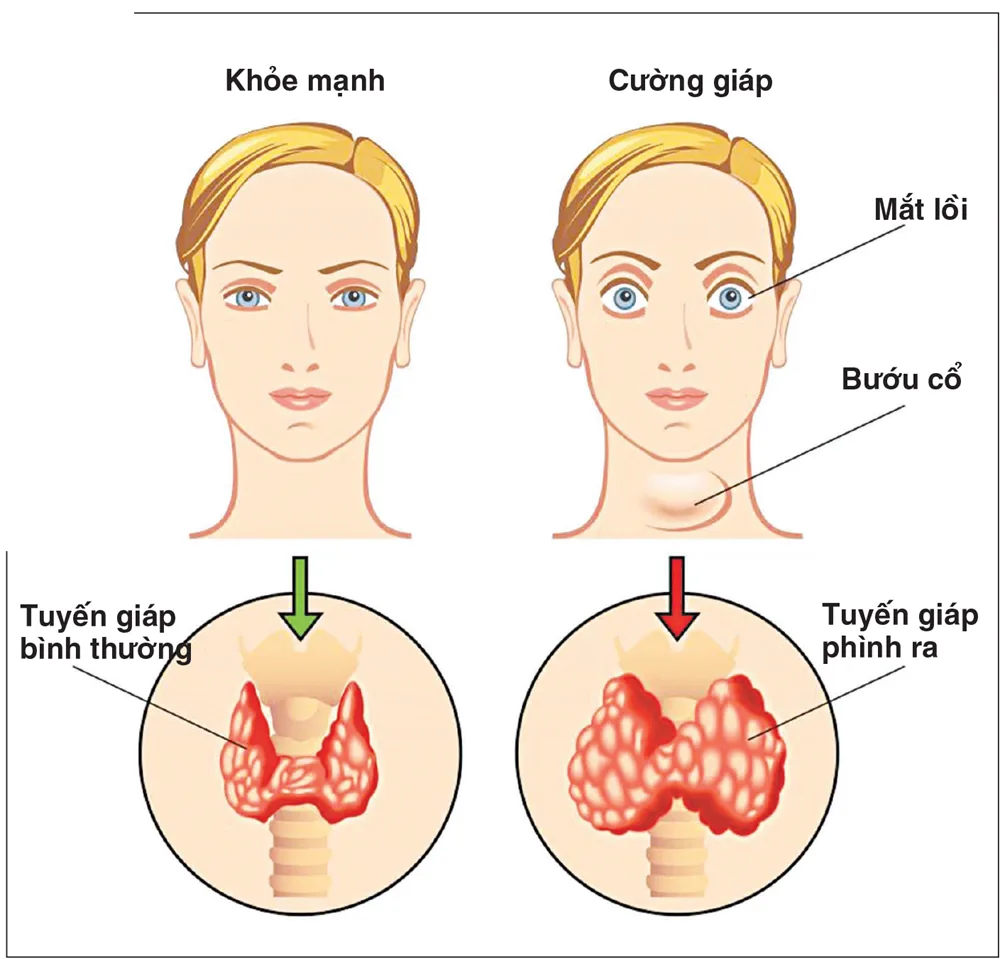 Bướu cổ nguyên nhân và cách phòng tránh 2 - Bệnh viện SANTE Bình Thạnh, TP.HCM