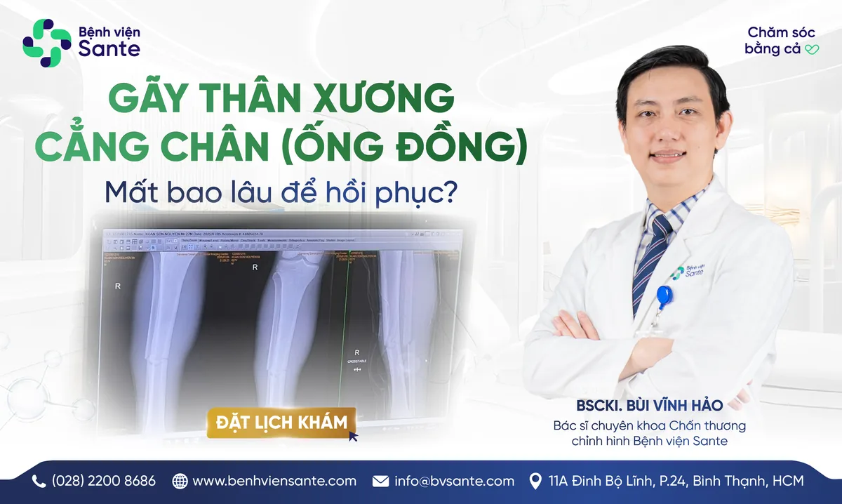 GÃY XƯƠNG CẲNG CHÂN (ỐNG ĐỒNG) MẤT BAO LÂU ĐỂ HỒI PHỤC? - Bệnh viện SANTE Bình Thạnh, TP.HCM