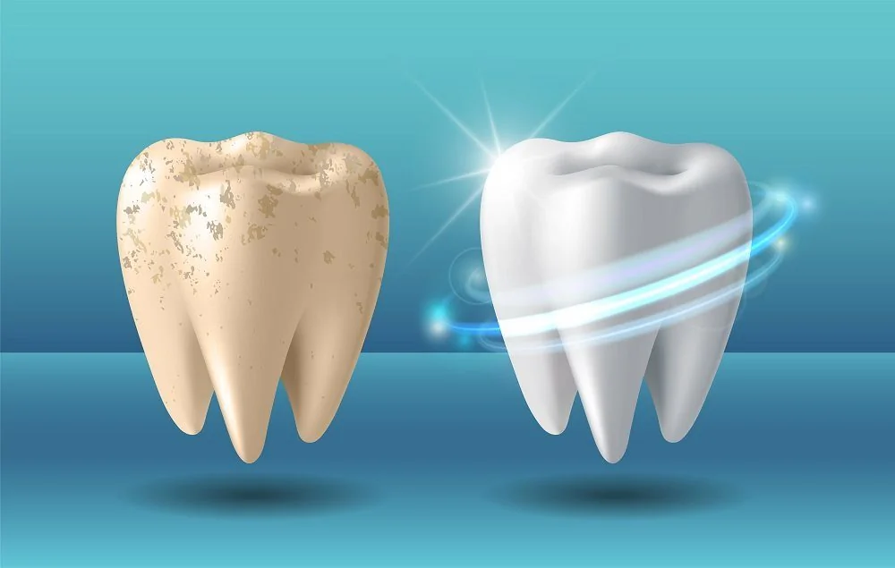 Bệnh viện Sante - Tẩy trắng răng (Hình 2)