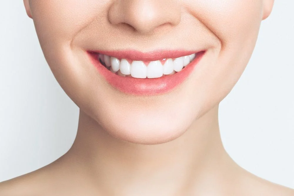 Bệnh viện Sante - Veneer sứ (mặt dán sứ) (Hình 3)