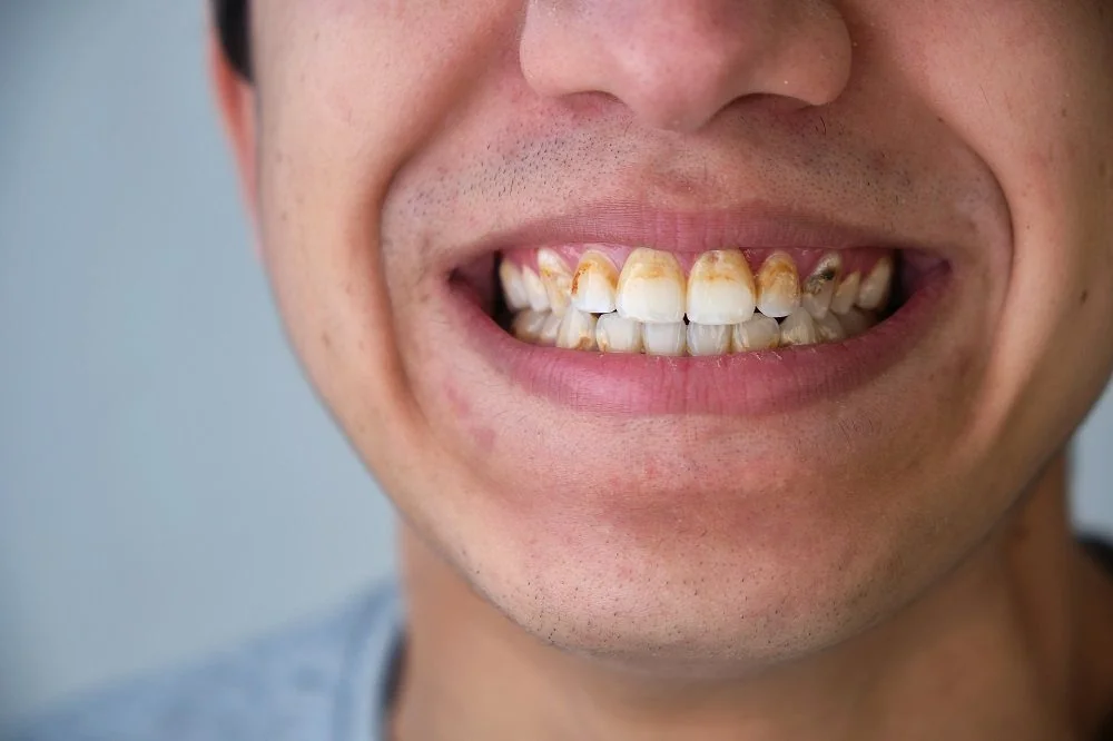 Bệnh viện Sante - Veneer sứ (mặt dán sứ) (Hình 4)