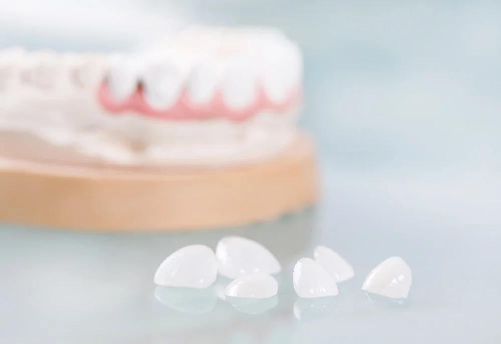 Bệnh viện Sante - Veneer sứ (mặt dán sứ) (Hình 2)