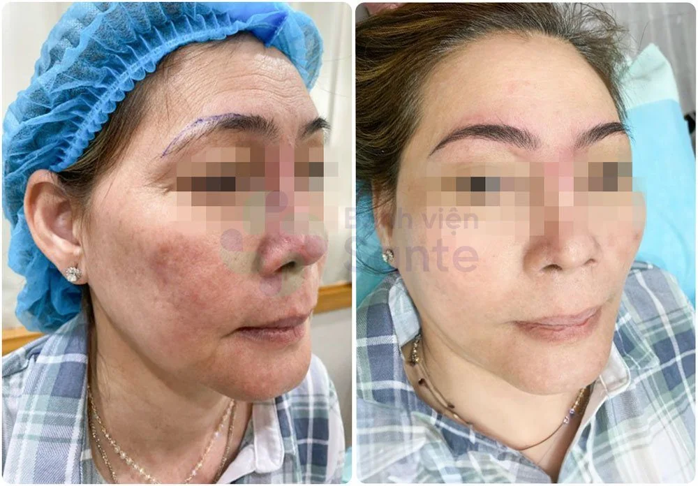 Sante Hospital - Aesthetic Semi-Permanent Makeup (Figure 2)
