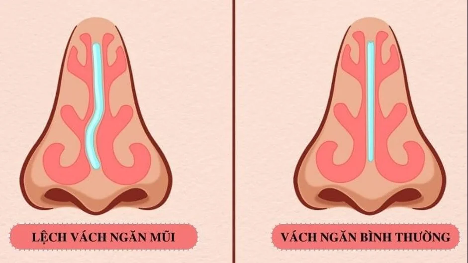 비중격 만곡증, 언제 수술이 필요할까요? - 상테(SANTE) 병원 빈탄점, 호치민시