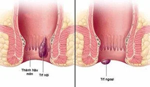 Bệnh viện Sante - Bệnh Trĩ