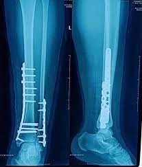 Kết hợp xương nẹp vis - Bệnh viện SANTE Bình Thạnh, TP.HCM