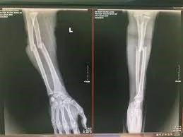 XQ gãy xương cẳng tay - Bệnh viện SANTE Bình Thạnh, TP.HCM