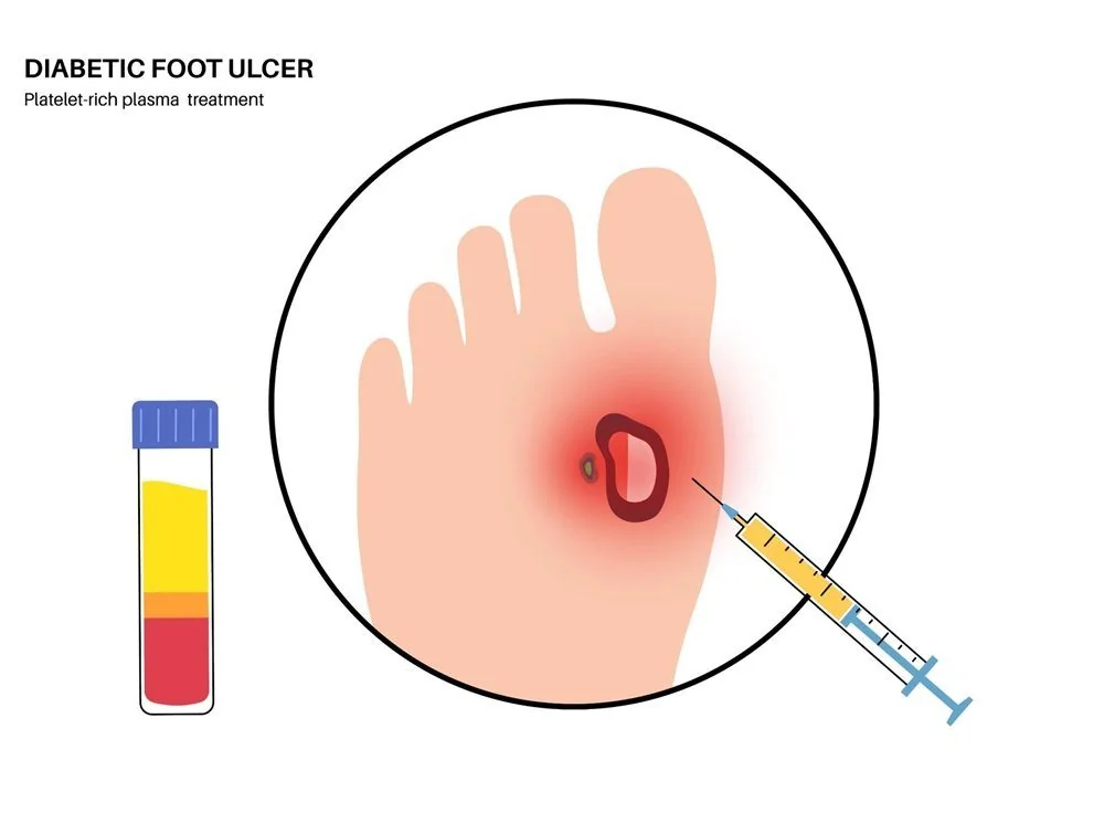 Bệnh viện Sante - Bệnh bàn chân đái tháo đường (Hình 3)