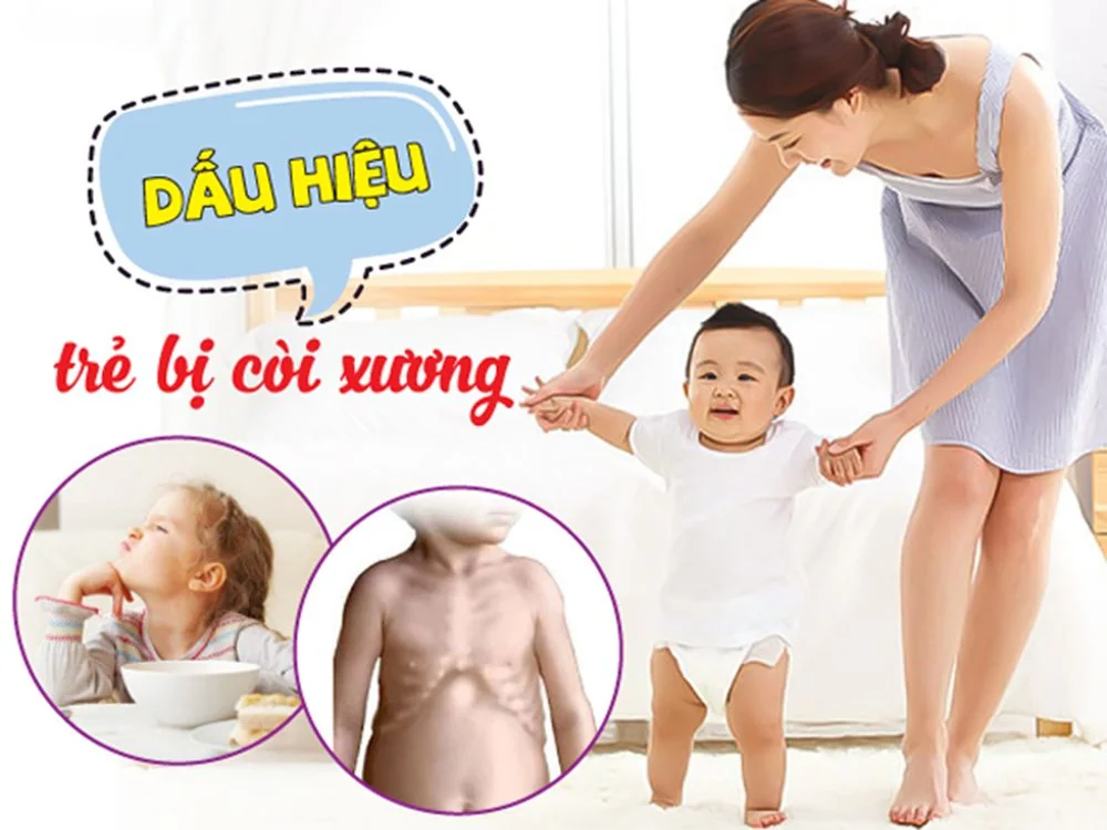 Bệnh viện Sante - Còi xương là bệnh như thế nào? Triệu chứng và cách chẩn đoán (Hình 3)