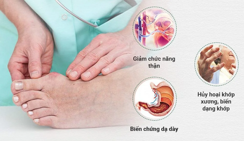 Bệnh viện Sante - Gout - Không còn là bệnh của người giàu (Hình 3)