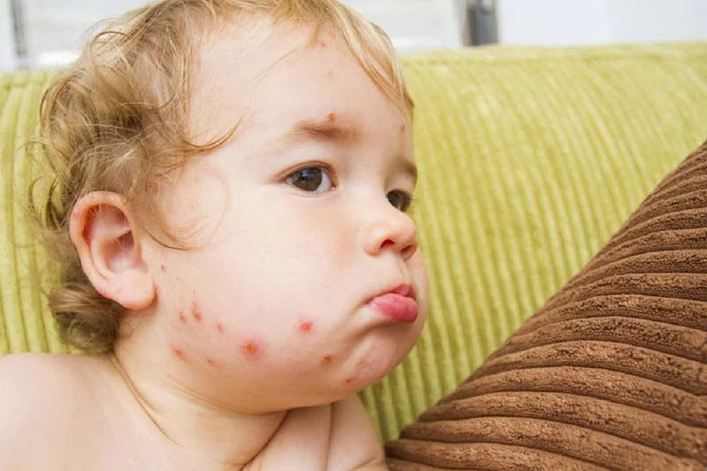 Bệnh viện Sante - Thuỷ đậu ở trẻ: Triệu chứng_ cách điều trị an toàn mẹ cần biết (Hình 2)