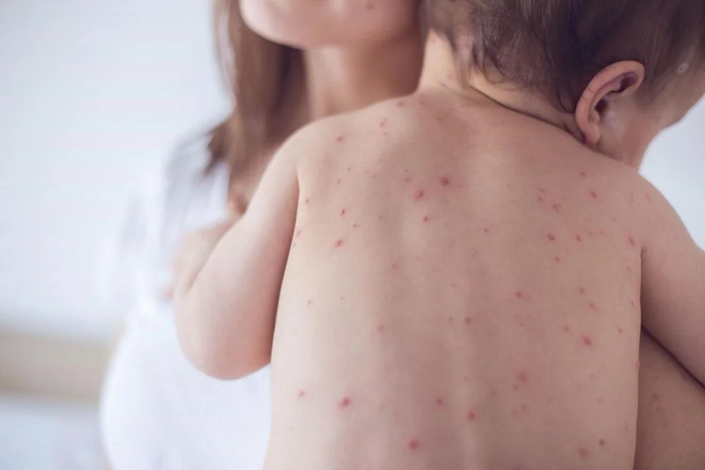 Bệnh viện Sante - Thuỷ đậu ở trẻ: Triệu chứng_ cách điều trị an toàn mẹ cần biết (Hình 4)