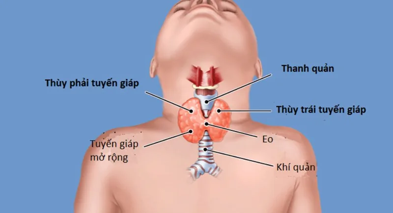 Bệnh viện Sante - Cường giáp là bệnh gì? Nguyên nhân_ dấu hiệu và cách chữa trị