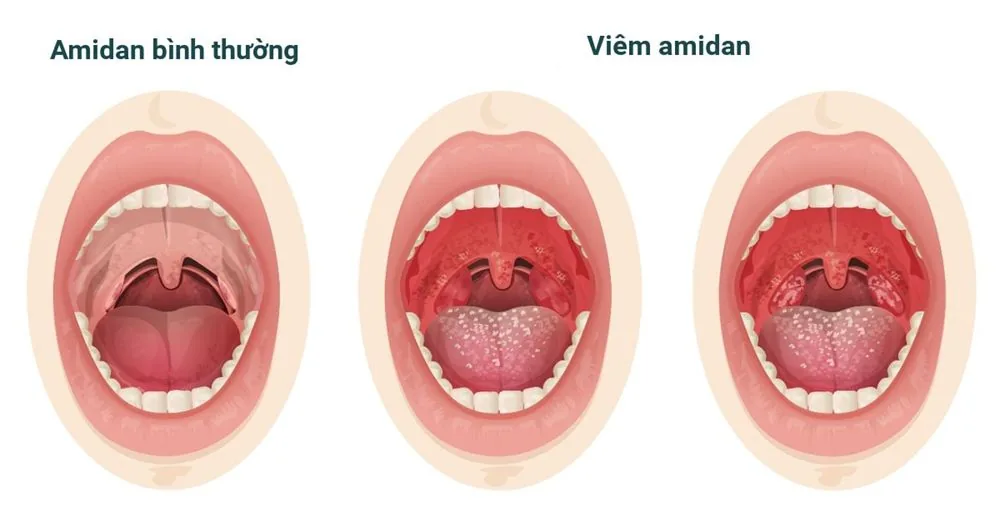 Bệnh viện Sante - Nguyên nhân nào dẫn đến đau họng? Triệu chứng_ cách chữa trị (Hình 4)