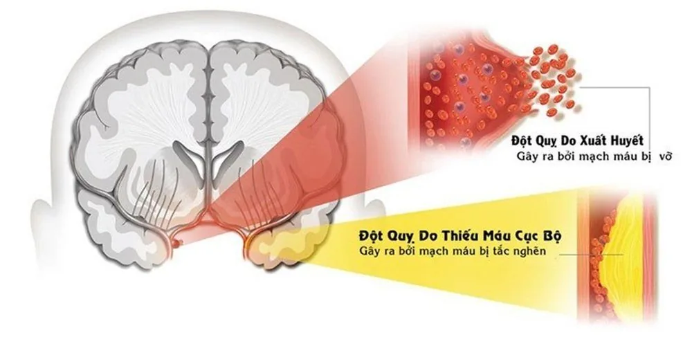 Đột quỵ và Stress: Những câu hỏi thường gặp - Hình 3 - Bệnh viện SANTE Bình Thạnh, TP.HCM