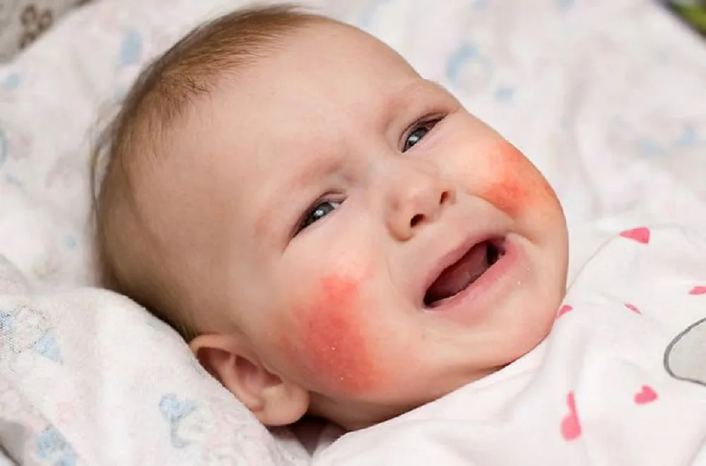 Bệnh viện Sante - Viêm da dị ứng ở trẻ: Nguyên nhân_ triệu chứng và cách điều trị (Hình 4)