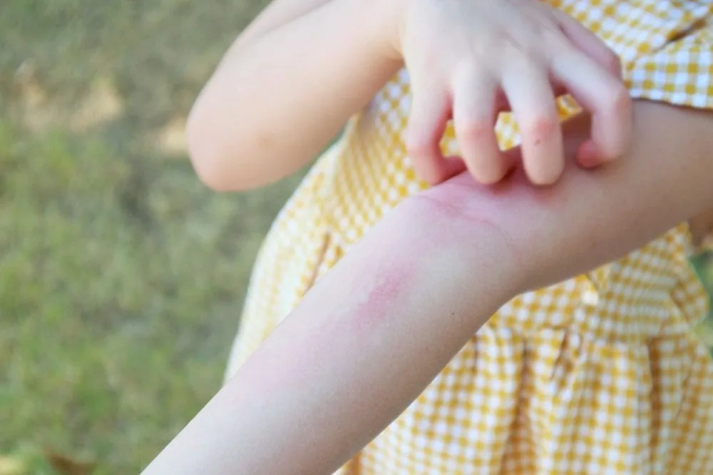 Bệnh viện Sante - Cách chăm sóc đúng tình trạng nổi mề đay ở trẻ nhỏ mẹ nên biết (Hình 4)