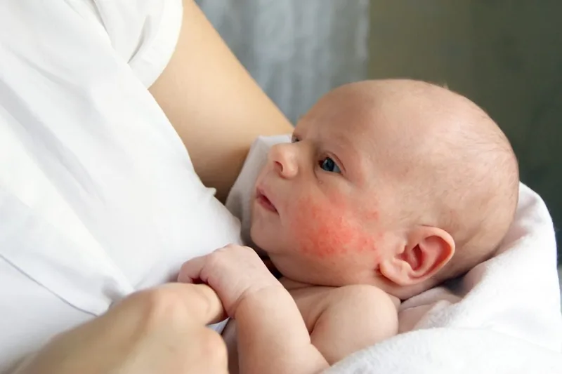 Bệnh viện Sante - Viêm da dị ứng ở trẻ: Nguyên nhân_ triệu chứng và cách điều trị