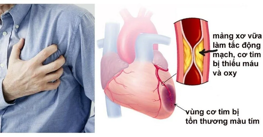 Bệnh viện Sante - Nhồi máu cơ tim - Hướng dẫn sơ cứu tại nhà (Hình 2)