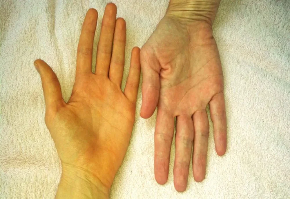 Bệnh viện Sante - Triệu chứng ung thư gan_ nguyên nhân_ đối tượng dễ mắc bệnh (Hình 2)
