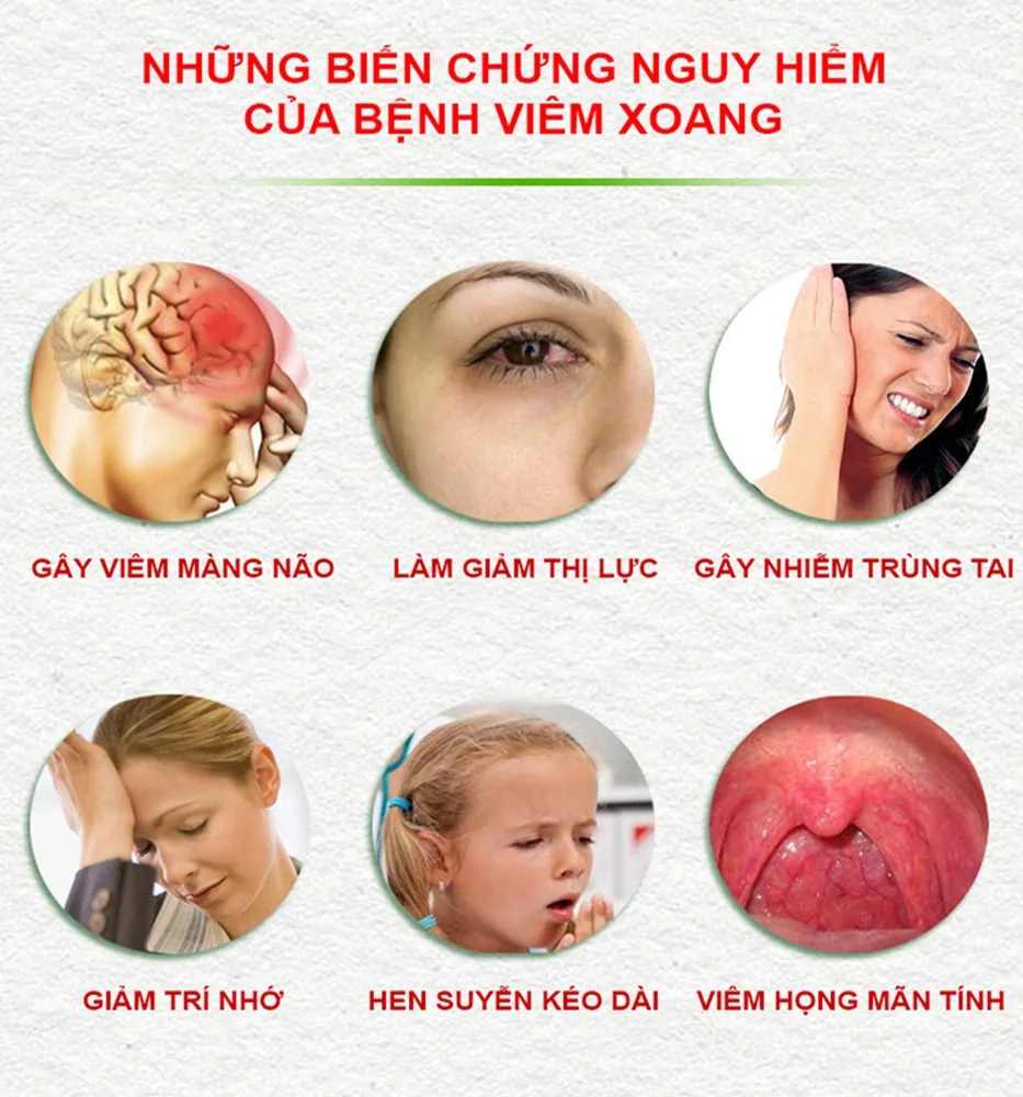 Bệnh viện Sante - Viêm mũi xoang và những nguy hiểm khôn lường (Hình 3)