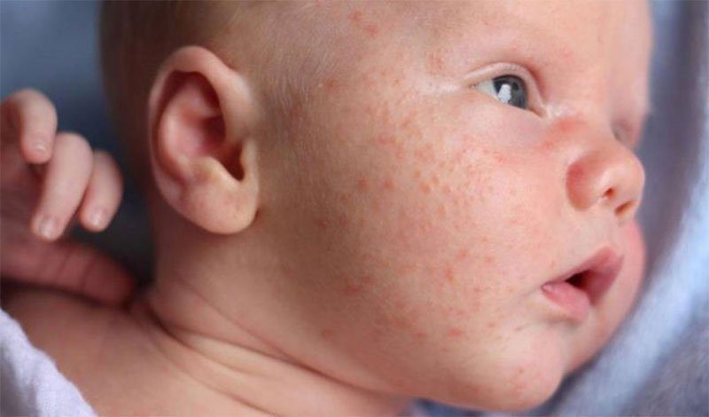 Rôm sảy ở trẻ: Nguyên nhân, cách điều trị và cách phòng ngừa