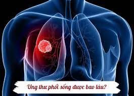 Ung thư phổi sống được bao lâu theo từng giai đoạn cụ thể