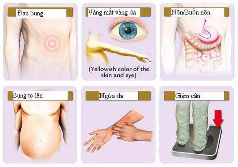 Triệu chứng ung thư gan, nguyên nhân, đối tượng dễ mắc bệnh