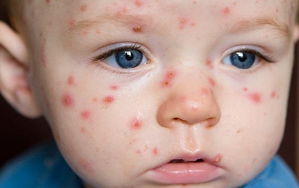 Vì sao trẻ nhỏ bị ung nhọt? Ung nhọt ở trẻ điều trị thế nào?