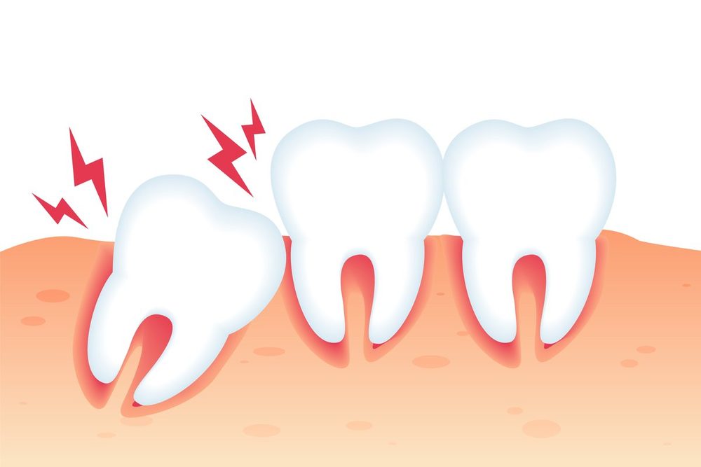 Có cần phải nhổ răng khôn không?