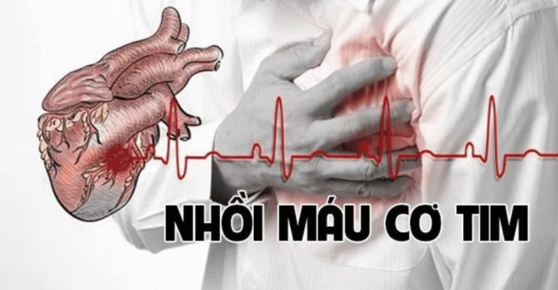 BẢO VỆ TRÁI TIM, BẢO VỆ CUỘC SỐNG: PHÒNG NGỪA NHỒI MÁU CƠ TIM