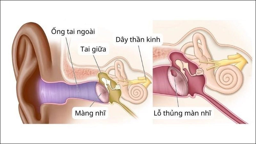 Thủng màng nhĩ – Nguyên nhân – Triệu chứng và cách phòng ngừa