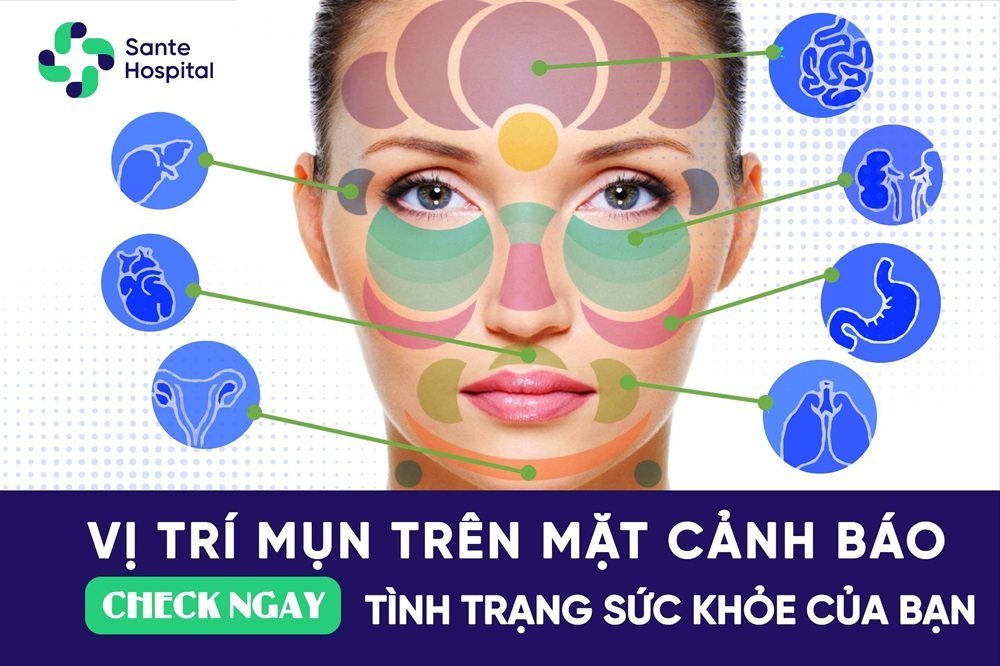 Những vị trí mụn trên khuôn mặt cảnh báo sức khỏe của bạn