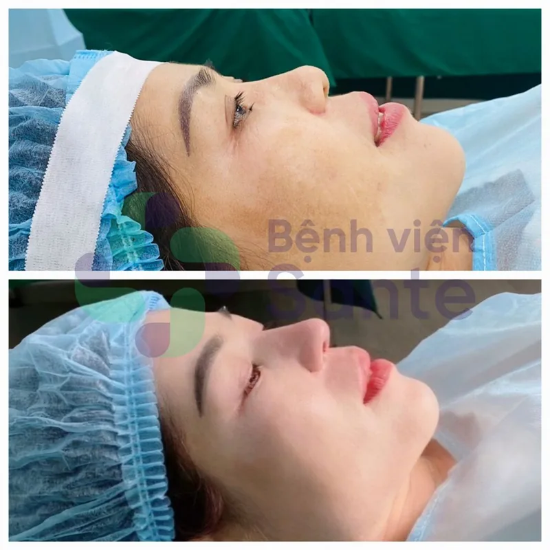 Dịch vụ phẫu thuật tạo hình thẩm mỹ mũi – Bệnh viện ngoại khoa Sante