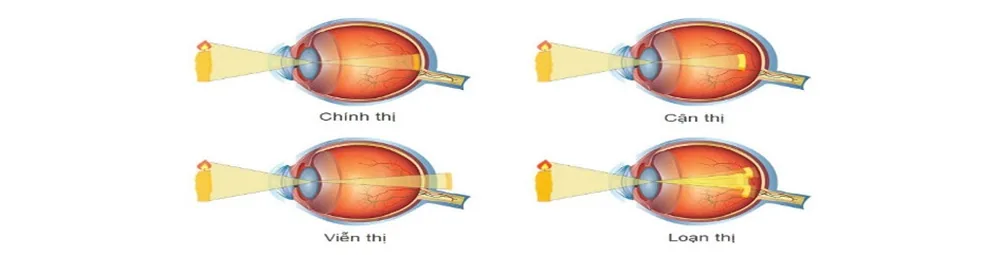 Những bệnh lý nguy hiểm thường gặp ở mắt ai cũng nên cảnh giác - Hình 4 - Bệnh viện SANTE Bình Thạnh, TP.HCM