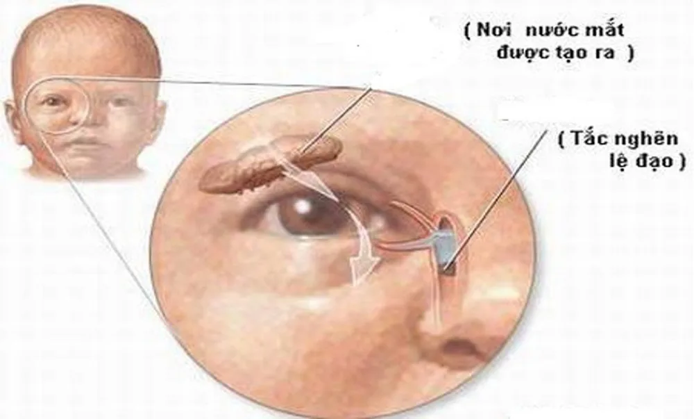 Những bệnh lý nguy hiểm thường gặp ở mắt ai cũng nên cảnh giác - Hình 9 - Bệnh viện SANTE Bình Thạnh, TP.HCM