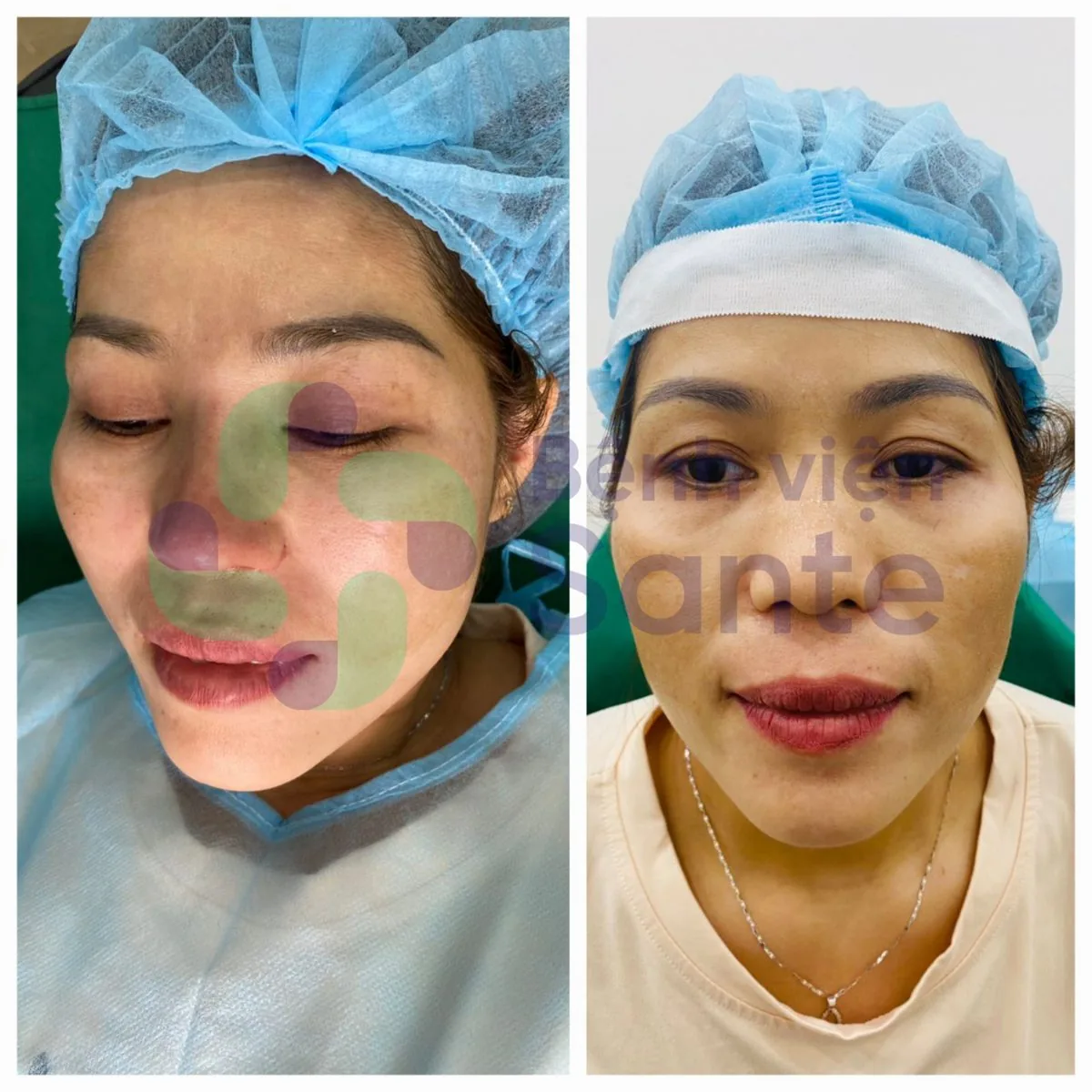 Phẫu thuật nâng mũi là gì? Bệnh viện chuyên khoa phẫu thuật nâng mũi chất lượng quốc tế HCM - Hình 2