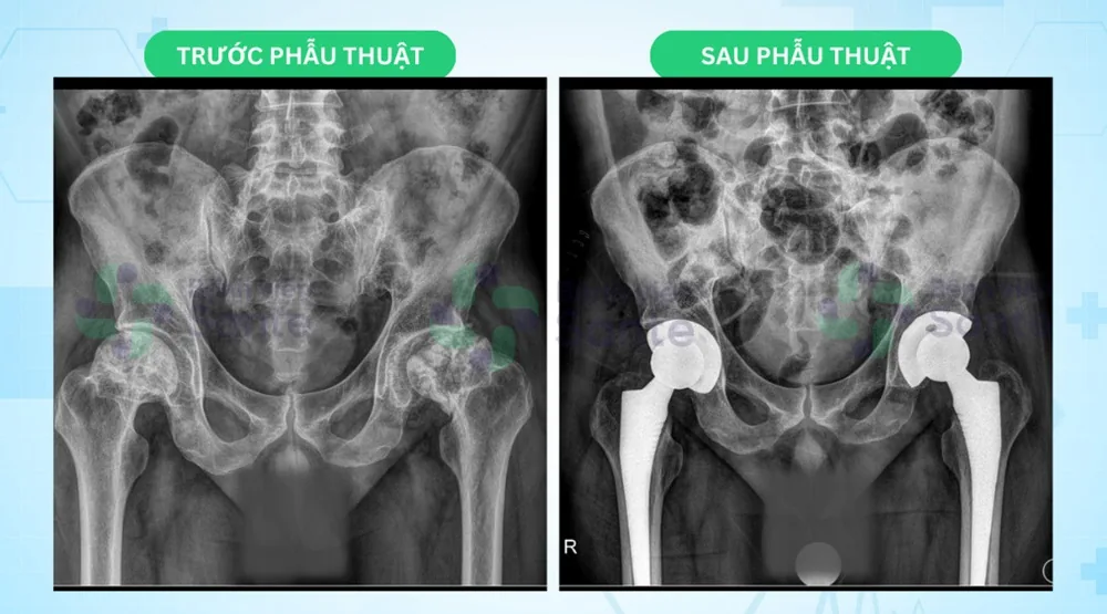 Returning for Contralateral Hip Replacement After 1 Month - Image 2 - SANTE Hospital, Binh Thanh, HCMC