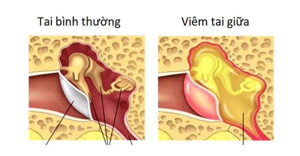 Tai chảy mủ có nguy hiểm không và cách xử lý khi tai bị chảy mủ - Bệnh viện SANTE Bình Thạnh, TP.HCM
