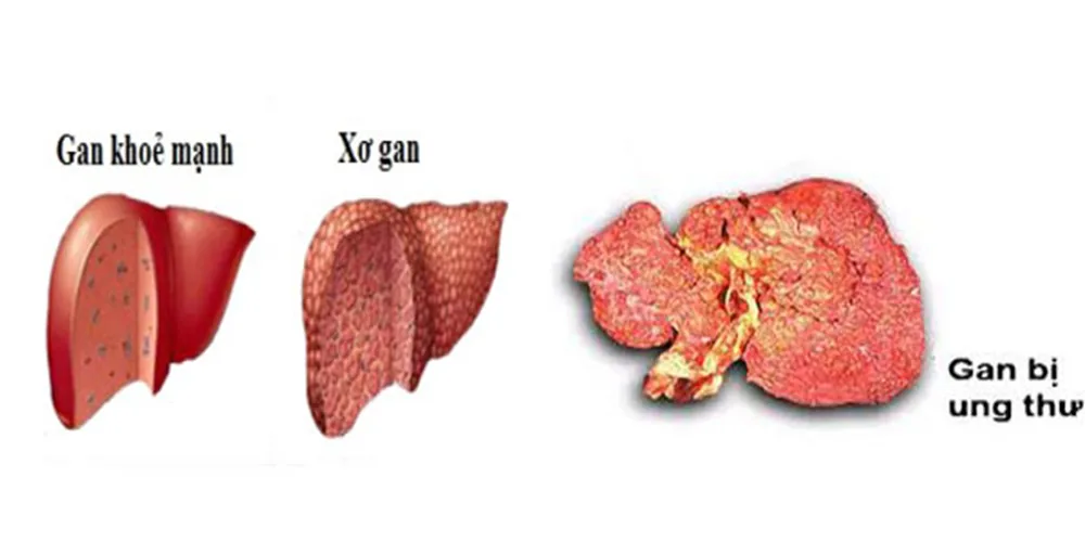 Dấu hiệu nhận biết xơ gan và ung thư gan 1 - Bệnh viện SANTE Bình Thạnh, TP.HCM