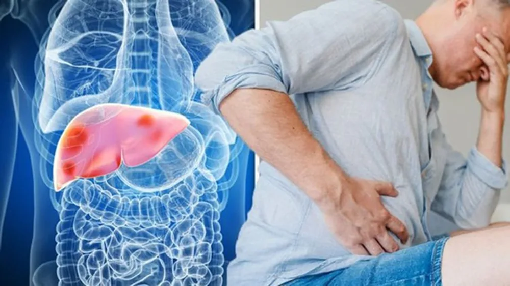 Dấu hiệu nhận biết xơ gan và ung thư gan 2 - Bệnh viện SANTE Bình Thạnh, TP.HCM